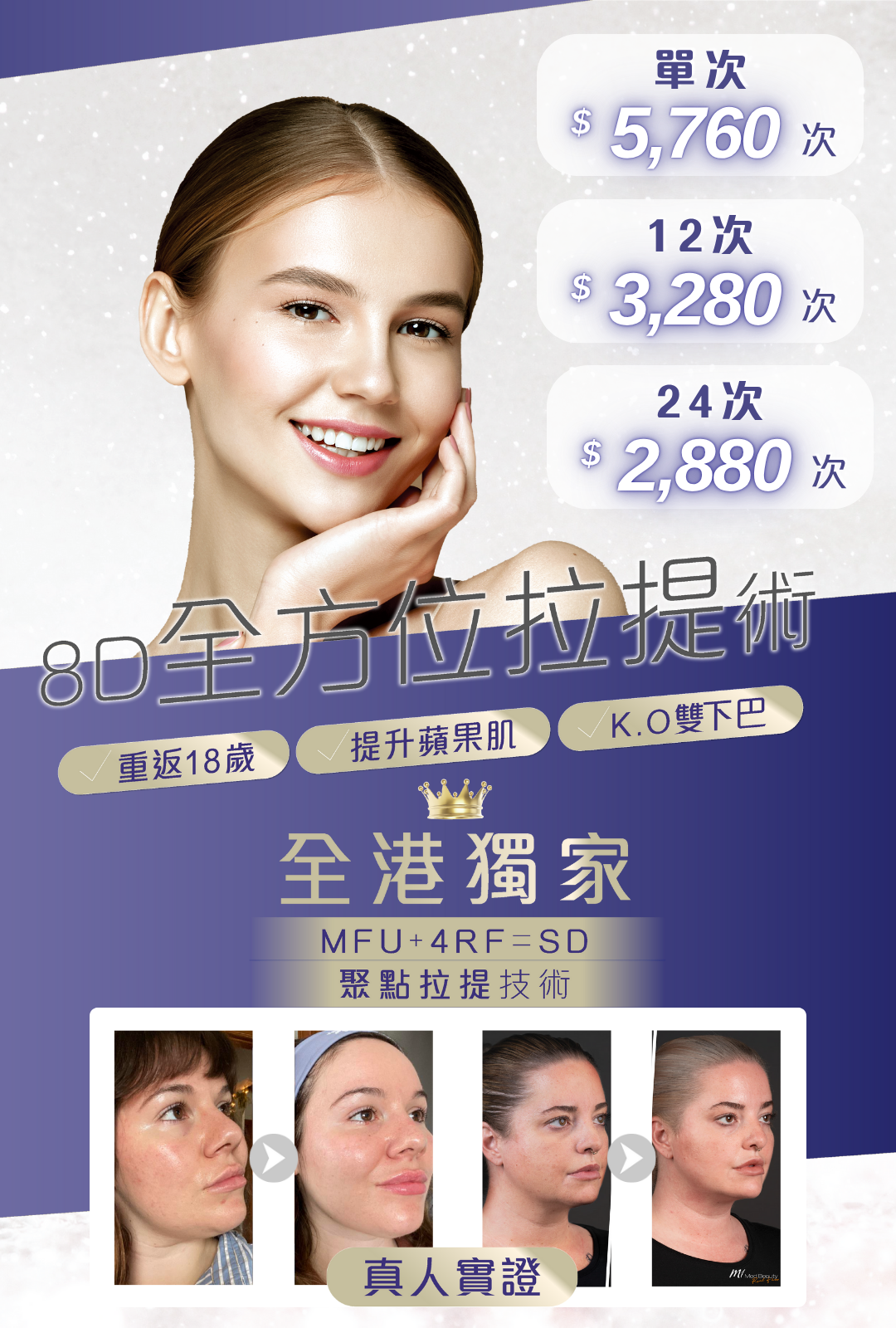 OctaLift 8D全方位拉提術