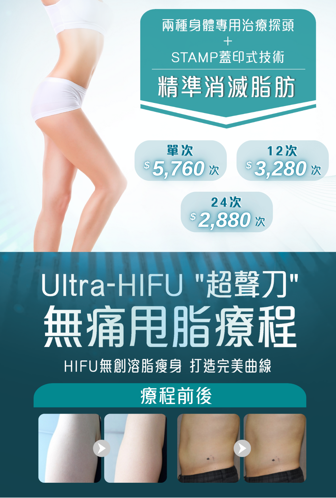 Ultra-HIFU "超聲刀"無痛甩脂療程